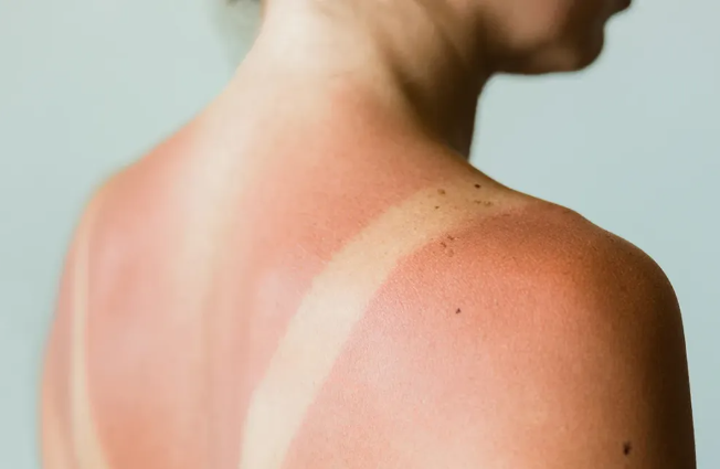 Marro Top Sunburn