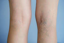 Do you have spider veins? You’re not alone.