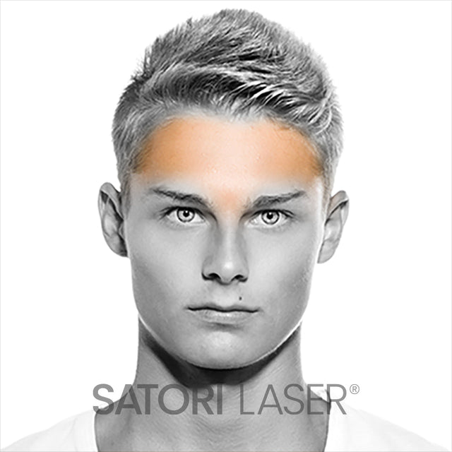Forehead - Satori Laser