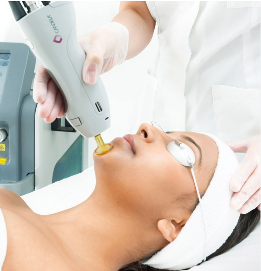 How Laser Hair Removal Ease PCOS-Related Hair Concerns?