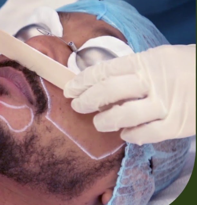 What is Beard Shaping Laser Hair Removal?