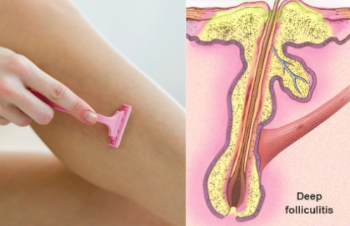 How Laser Hair Removal Precents Folliculitis?