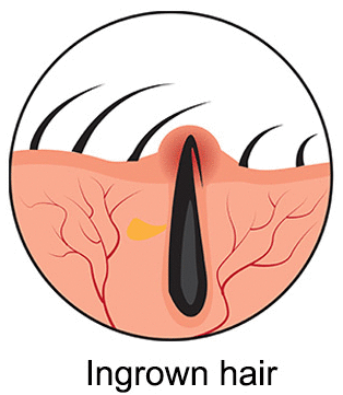 How to Get Rid of Ingrown Hair?