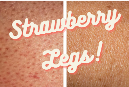 How to Get Rid of Strawberry Legs?