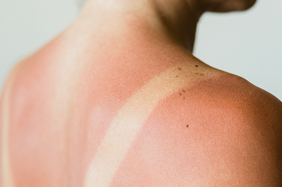 Protecting Your Skin Before and After Laser Hair Removal from Sun Exposure