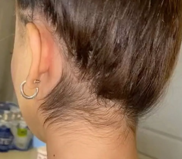Can Laser Hair Removal Fix Your Hairline?