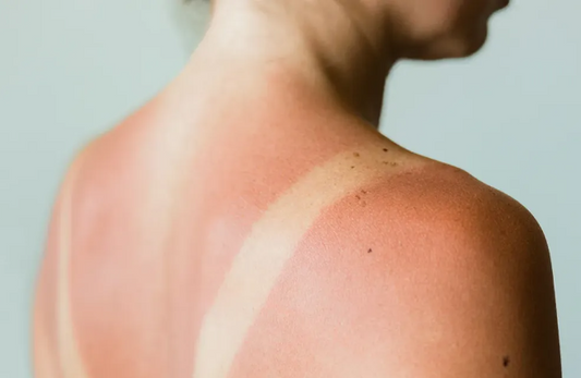 5 Essential Tips for Recovering from Sunburn