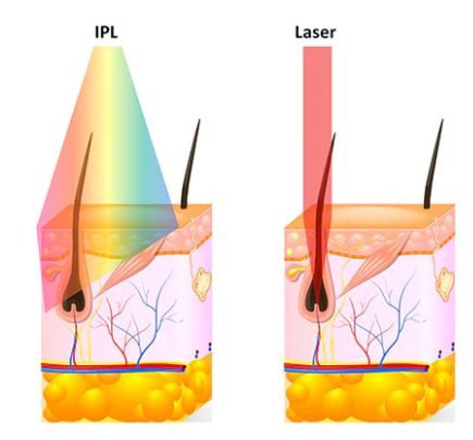 What is the difference between Laser Hair Removal and IPL