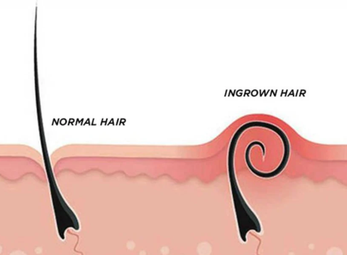 Ingrown Hairs and the Benefits of Laser Hair Removal