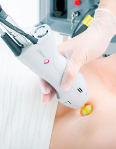 Does Laser Hair Removal cause Underarm Odor?