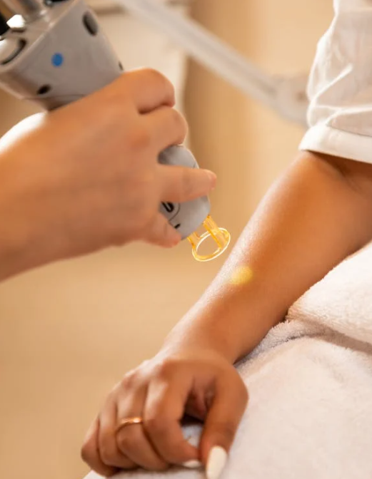 My Full Arm Laser Hair Removal Experience