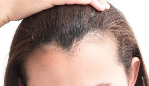 How Laser Hair Removal Can Transform Your Hairline?