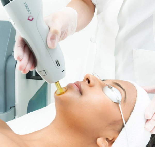How Often Do I Need to Get Laser Hair Removal?