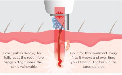 Why Cryogen Cooling is the Best Method for Laser Hair Removal: A Comparison to Other Cooling Techniques