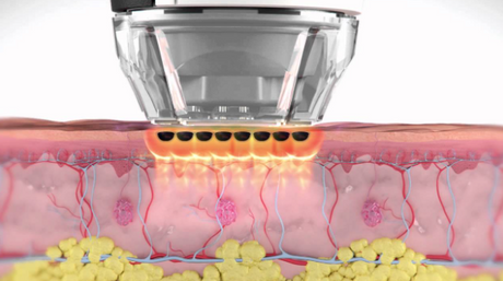 Can EMATRIX Remove Wrinkles?