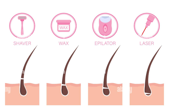 Laser Hair Removal vs. Waxing: Which Is Better for Long-Term Results?