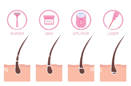Laser Hair Removal vs. Waxing: Which Is Better for Long-Term Results?