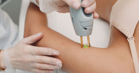 Top 5 Myths About Laser Hair Removal Debunked