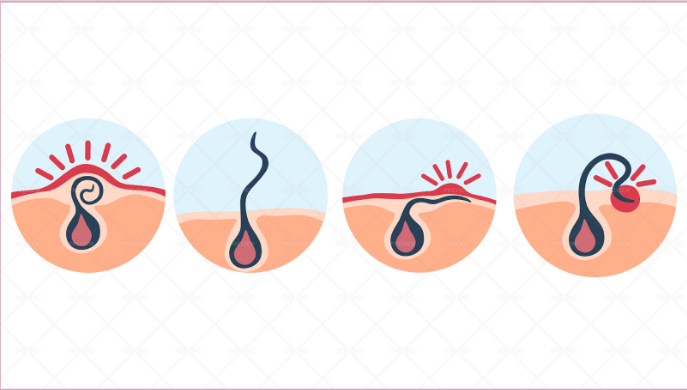 Say Goodbye to Ingrown Hairs: How Laser Hair Removal Can Help