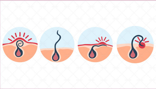 Say Goodbye to Ingrown Hairs: How Laser Hair Removal Can Help