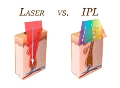 Is At-Home Laser Hair Removal Worth It?