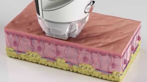 Can eMatrix Help with Stretch Marks? Here’s What You Need to Know