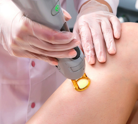 Why Laser Hair Removal Results Look Patchy at First