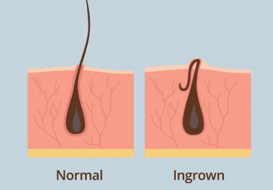 Scrub Too Hard? How Over-Exfoliating Makes Ingrown Hairs Worse