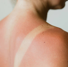 Why Can't You Get Laser Hair Removal on Freshly Tanned Skin?