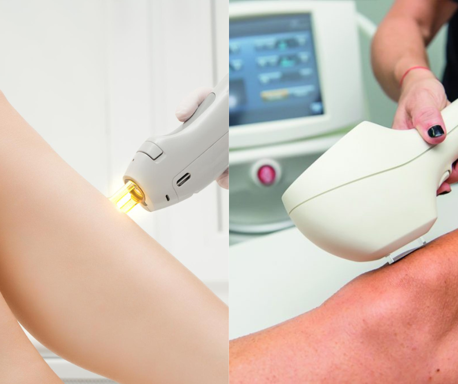 Difference between IPL and Lasers?