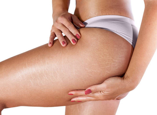 Stretch Marks!