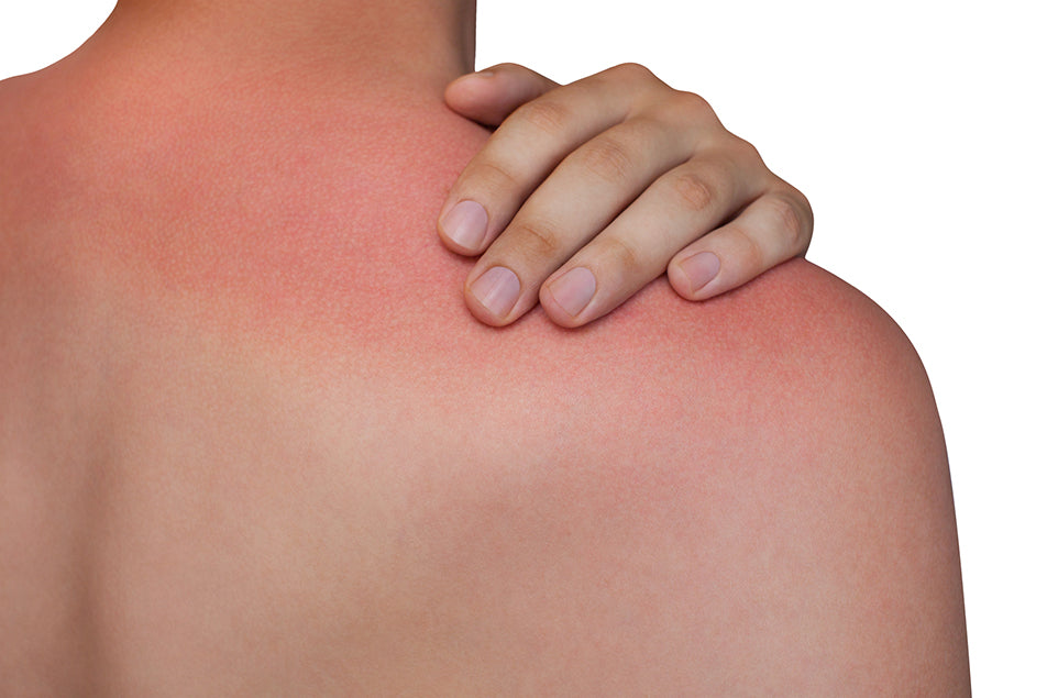 Recovering from a Sunburn