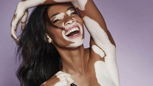 Vitiligo and Laser Hair Removal