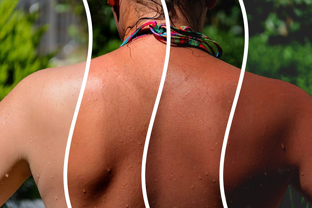 Can You Get a Spray Tan During Laser Hair Removal Treatment?
