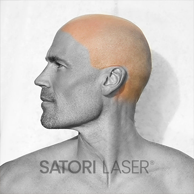 Scalp Laser Hair Removal Satori Laser