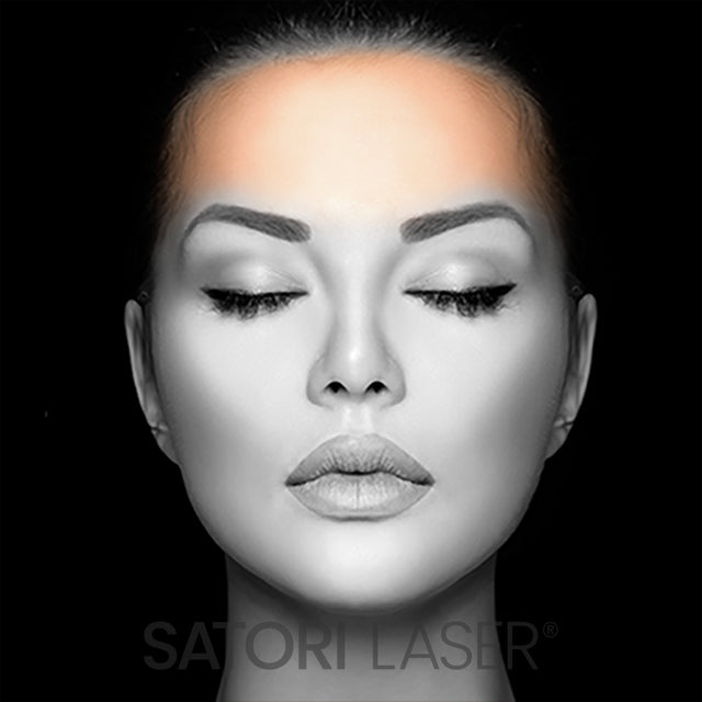 Forehead (F) - Satori Laser