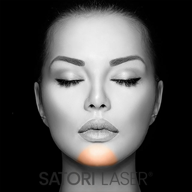 Chin (F) - Satori Laser