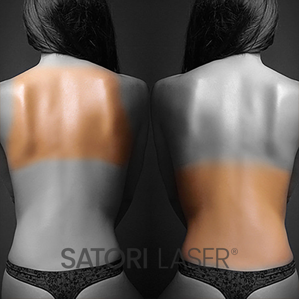 1/2 Back (F) - Satori Laser