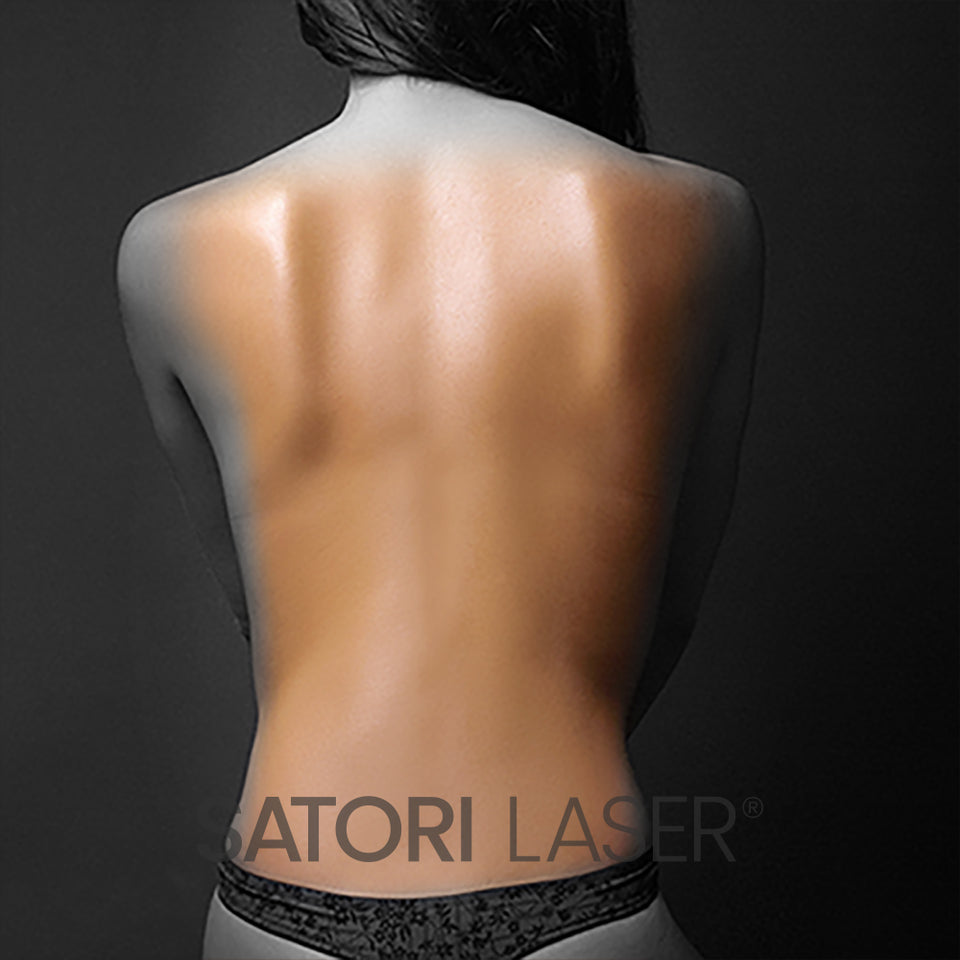 Female Full Back laser hair removal area - Satori Laser