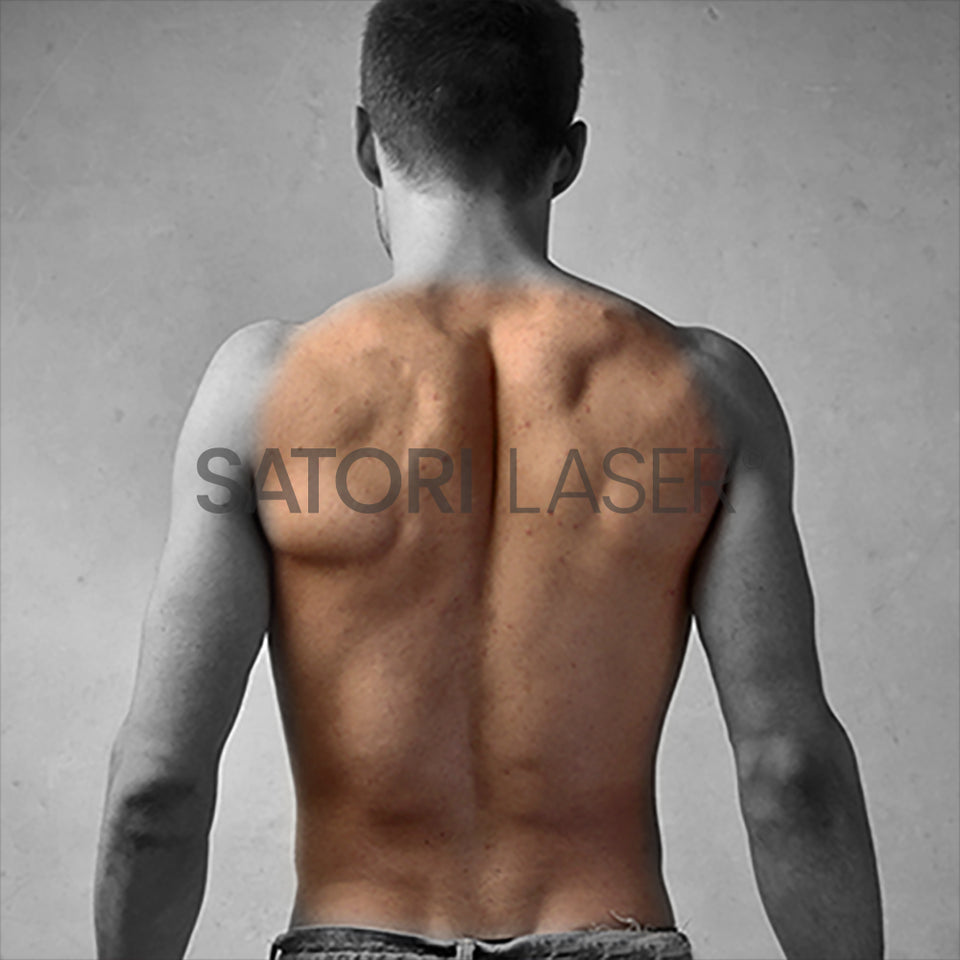 Male Full Back laser hair removal area