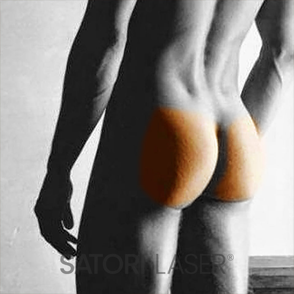 Buttocks - Satori Laser