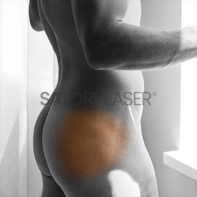 Hips - Satori Laser