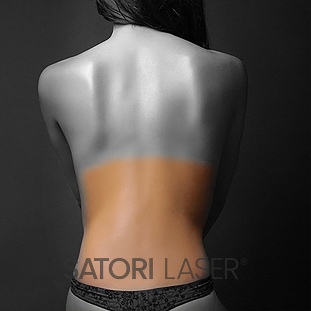 Lower Back Stretch Marks eMatrix - Satori Laser